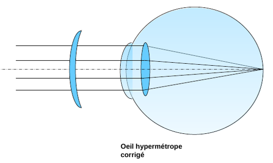 Hypermetrope lunette gros discount yeux